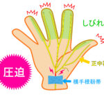手根管症候群(手指のしびれ)の鍼灸治療