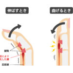 ばね指のリハビリと治療